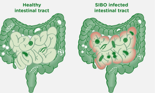 SIBO